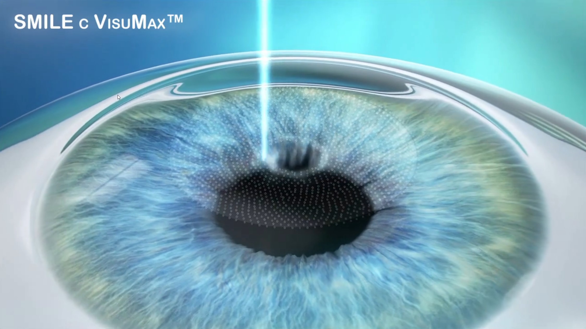 Лазерная коррекция зрения спустя много лет отзывы. Фемто ласик. Офтальмология Фемто ласик. Лазерная коррекция зрения Femto super LASIK.
