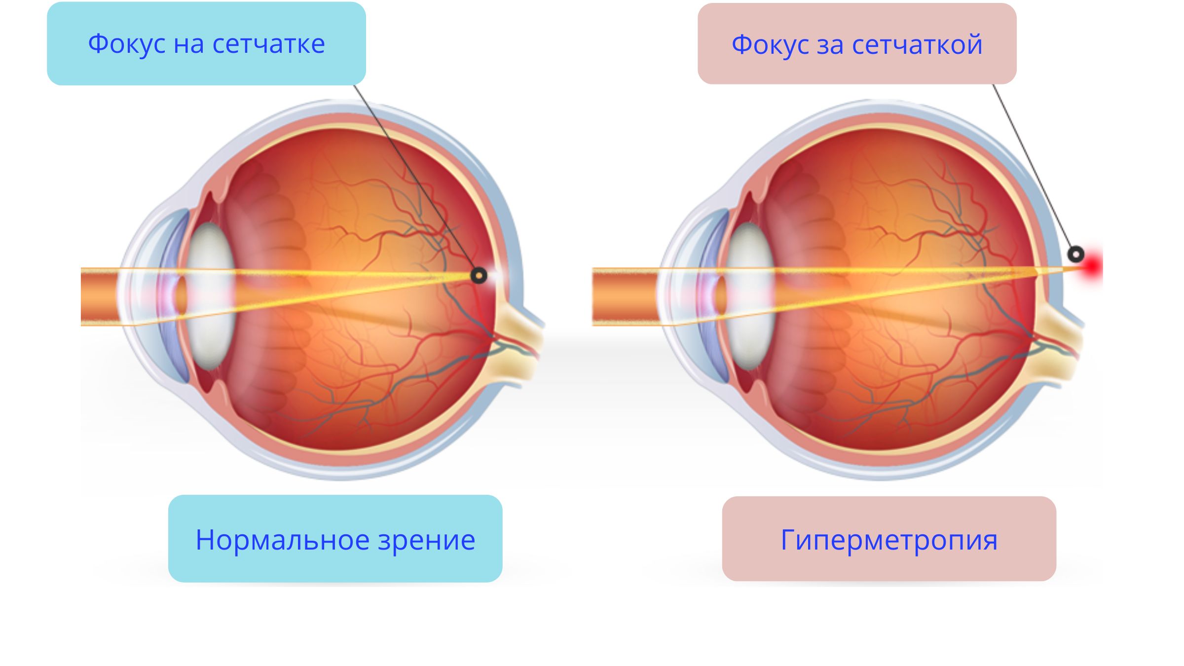 Гиперметропия средней степени глаза. Миопия и гиперметропия. При близорукости лучи света фокусируются. Дефекты зрения. Гиперметропия возрастная.