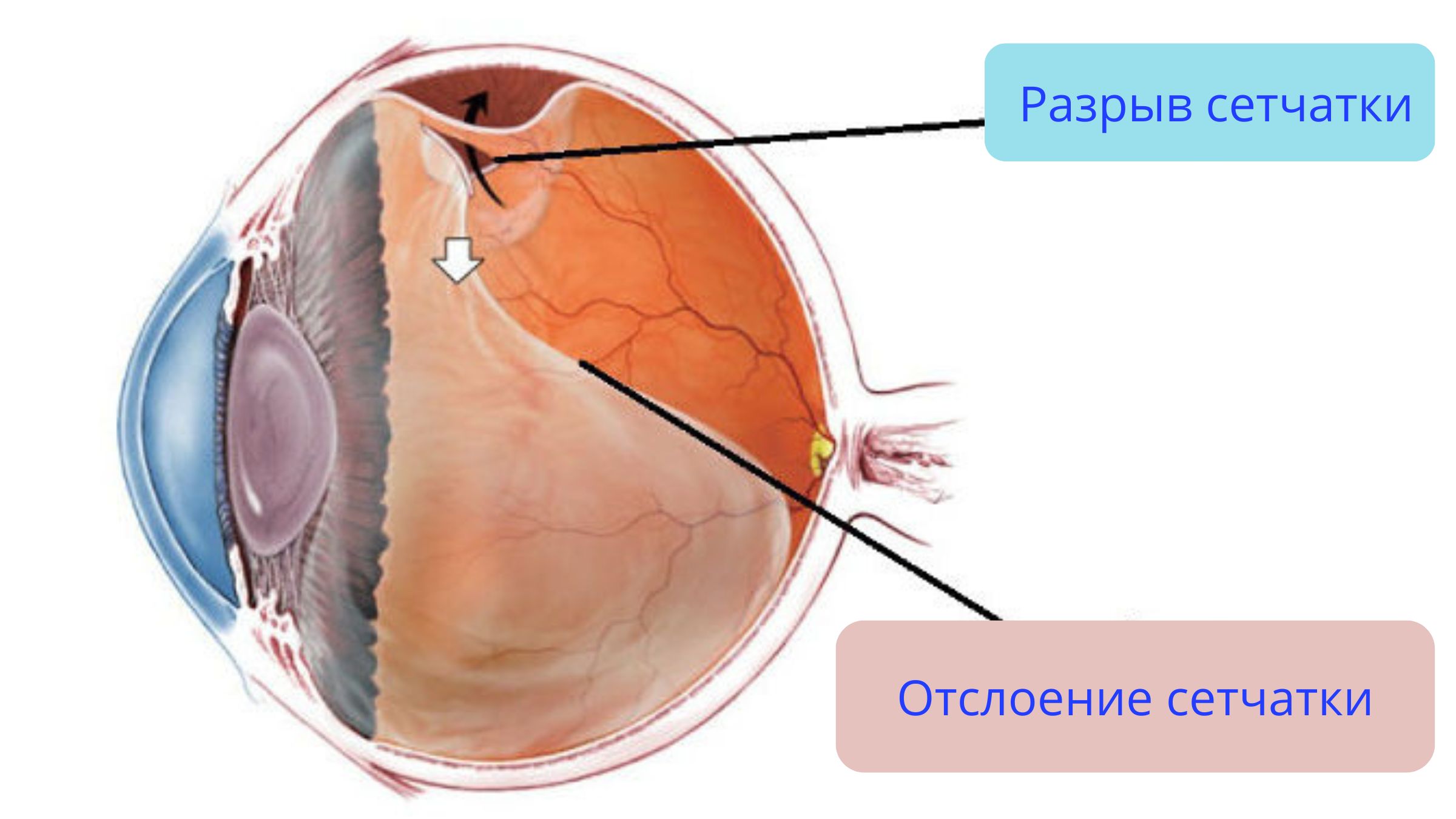 Отслойка сетчатки причины. Регматогенная отслойка сетчатки глаза. Субтотальная отслойка сетчатки. Отслоение сетчатки глаза схема. Отслойка сетчатки макулярный разрыв.