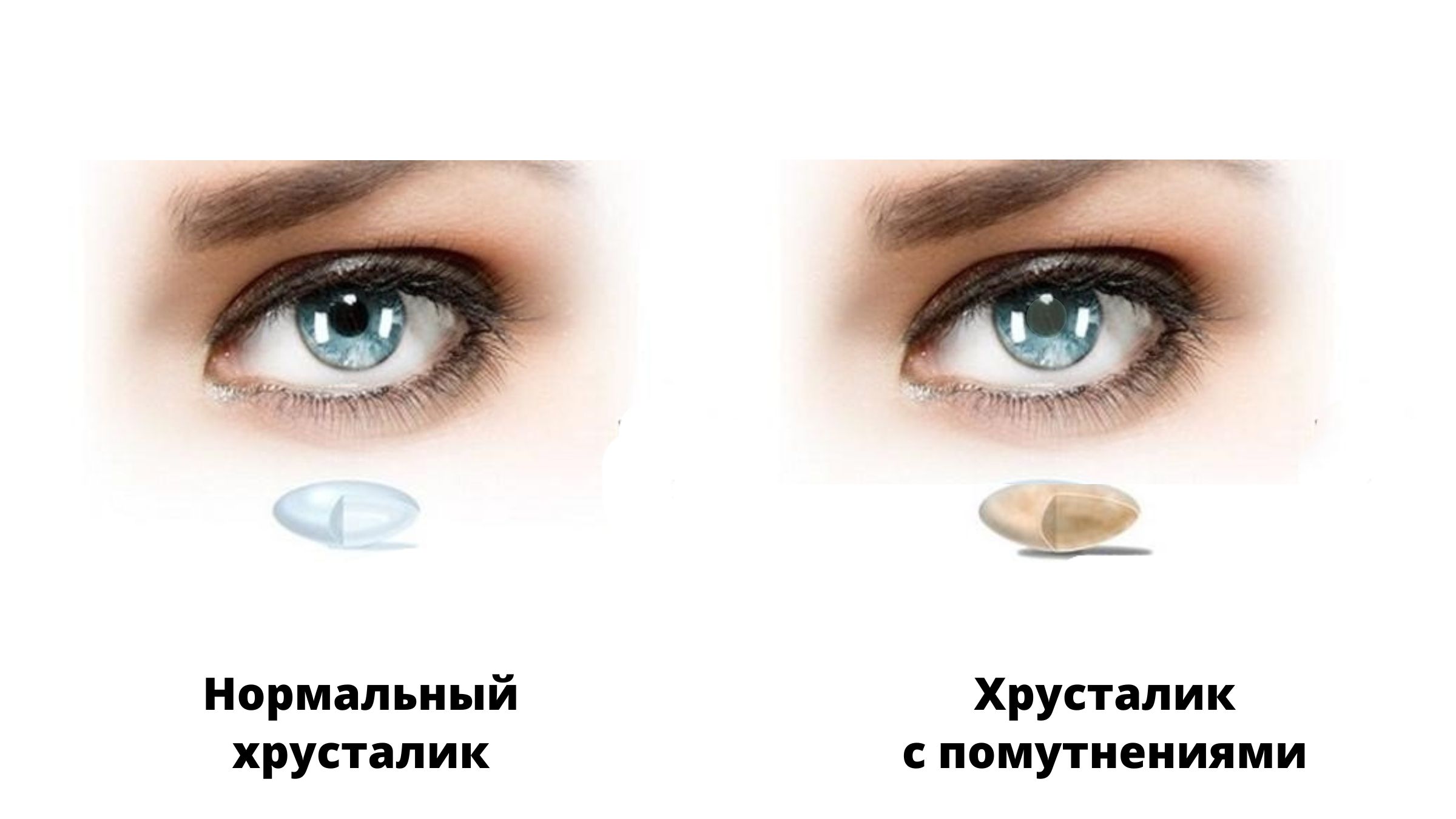 Каковы симптомы катаракты?